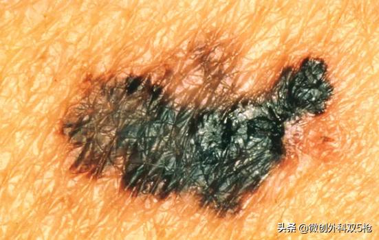 身上黑痔小心要了命！掌握ABCDE原则，教你肉眼判断黑色素瘤