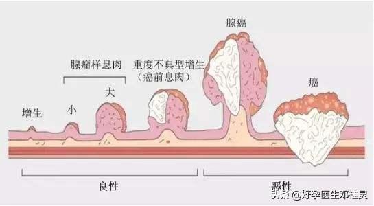 子宫内膜多发息肉宫腔镜能根除吗,子宫内膜异位症输卵管粘连不孕