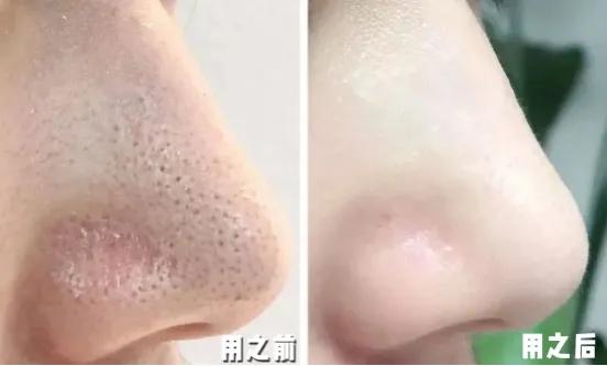 深度清理毛孔黑头教程,清洁毛孔里的黑头和白头小妙招