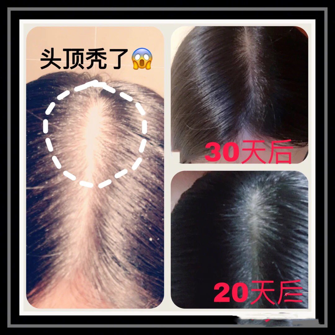 严重自来卷前额碎发巧妙处理,如何做到不秃头