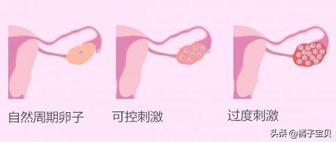 卵巢过度刺激综合征怎么得的,卵巢过度刺激综合征要用白蛋白吗