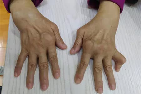 关节类风湿治疗原则,用中药哪种是治疗类风湿最佳方案