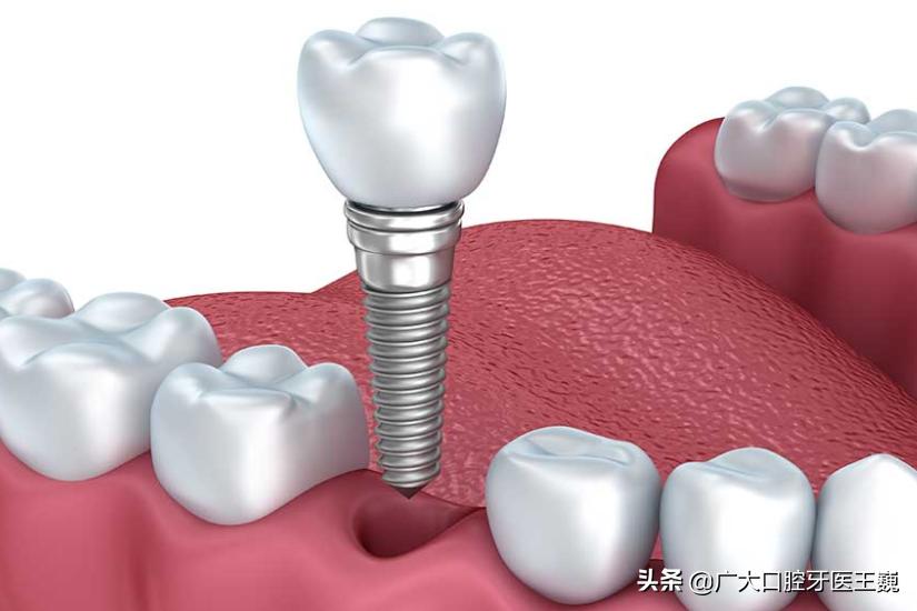 老年人缺牙怎样解决最好,中老年缺牙怎么办