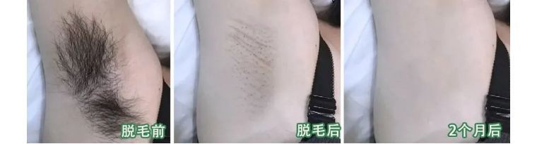 j-style脱毛仪怎么用,j-style脱毛仪怎样