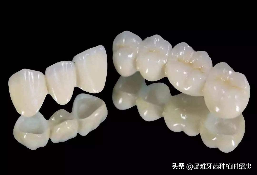 400与300块钱的烤瓷牙有多大区别,为什么有的全瓷牙贵有的便宜