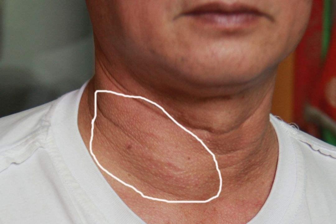 胸后甲状腺肿会引起胸痛吗,甲状腺结节会有胸闷气短的症状吗