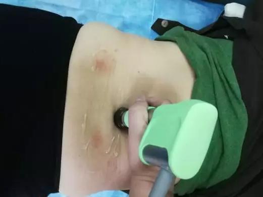 冲击疗法详细介绍,冲击疗法属于什么疗法