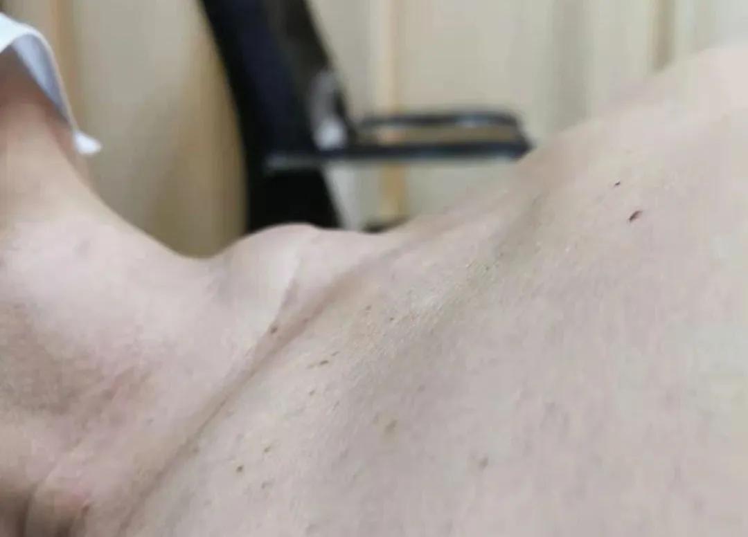 甲状腺囊肿介入,甲状腺囊肿介入治疗效果如何