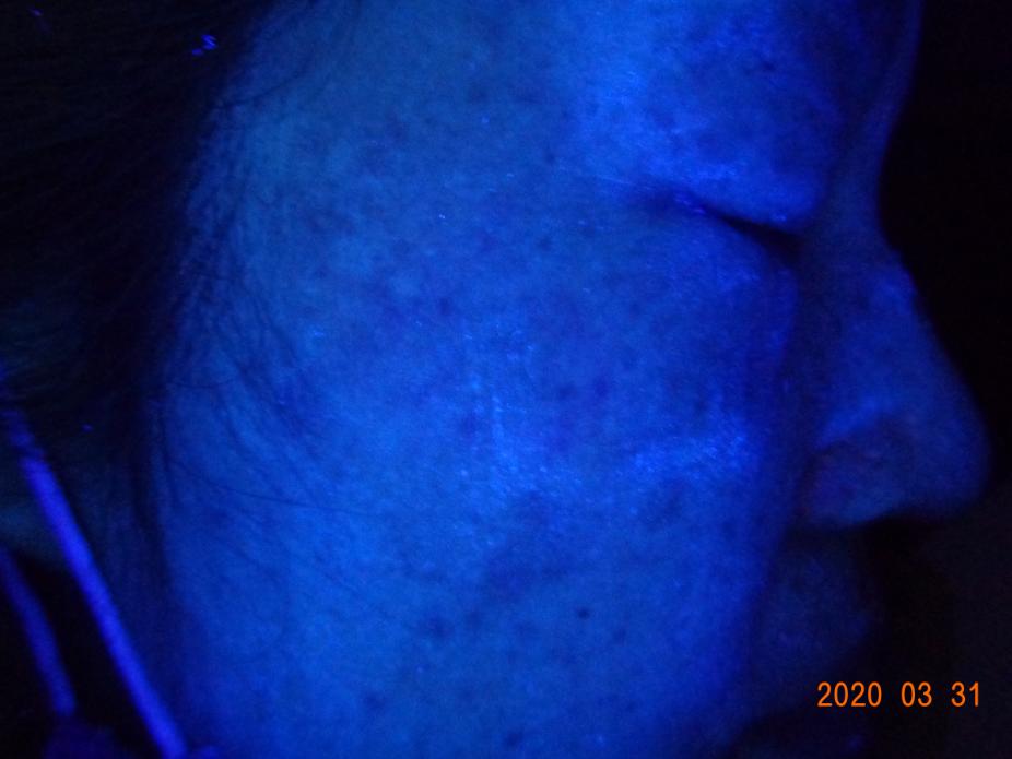 一位散发型白癜风患者的自白：坚持治疗能痊愈，千万别放弃自己