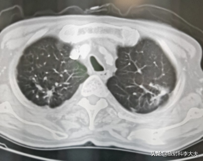 几年前得过肺结核现在胸透有阴影,结核治疗一年了还有胸痛