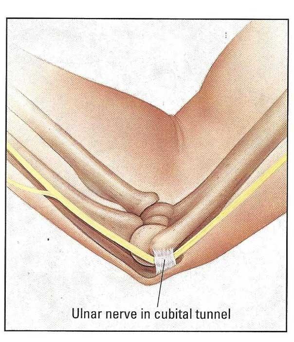 “医生,我胳膊肘伸不直了,还用不了筷子了,我是怎么了啊?”