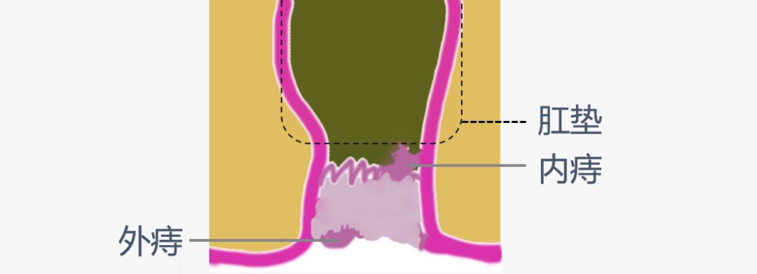 莲雾治痔疮的最佳方法,毫菊及杭白菊对痔疮有治疗作用吗
