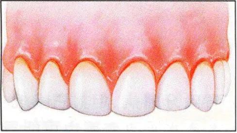 慢性乙肝患者牙龈出血意味着什么,乙肝牙龈出血能补维c吗