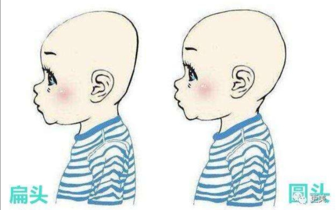 宝宝头睡偏了长大能自动恢复吗,宝宝头睡偏了用定型枕有用吗