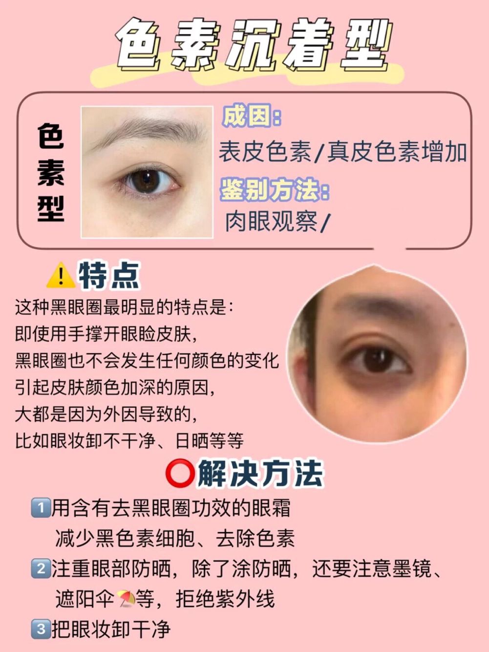如何去色素型黑眼圈,去色素型黑眼圈最有效的方法