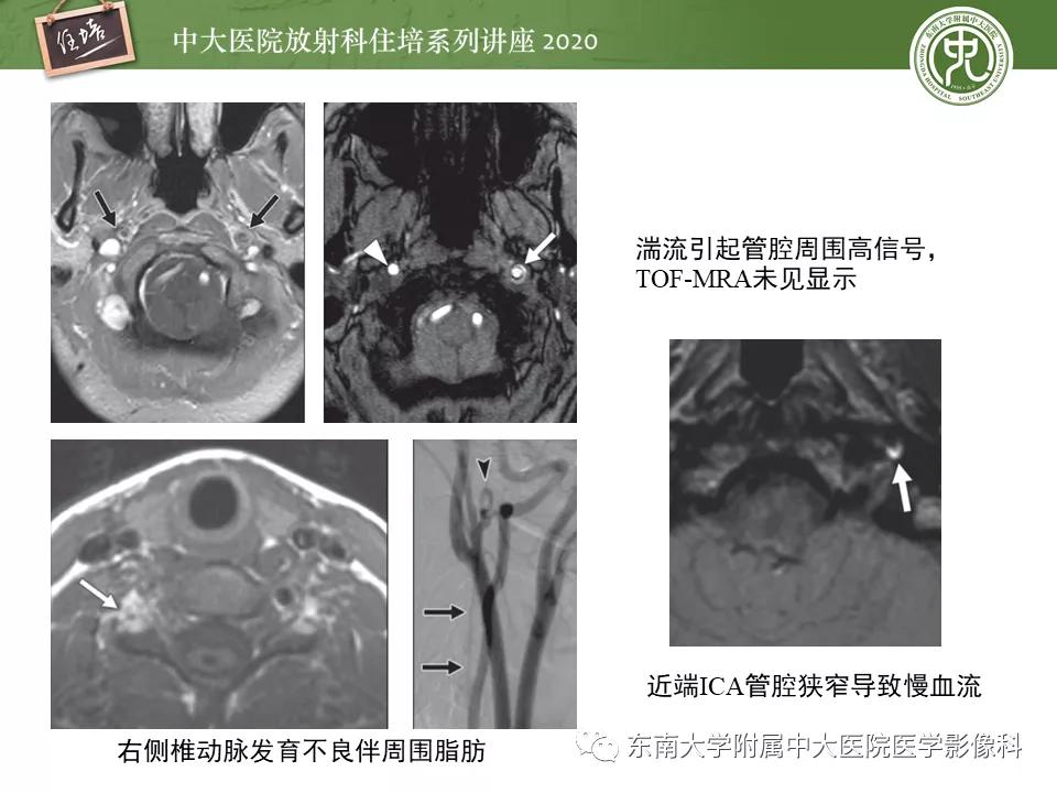 颈动脉夹层的超声表现及漏诊分析,动脉夹层与夹层动脉瘤是一样的吗