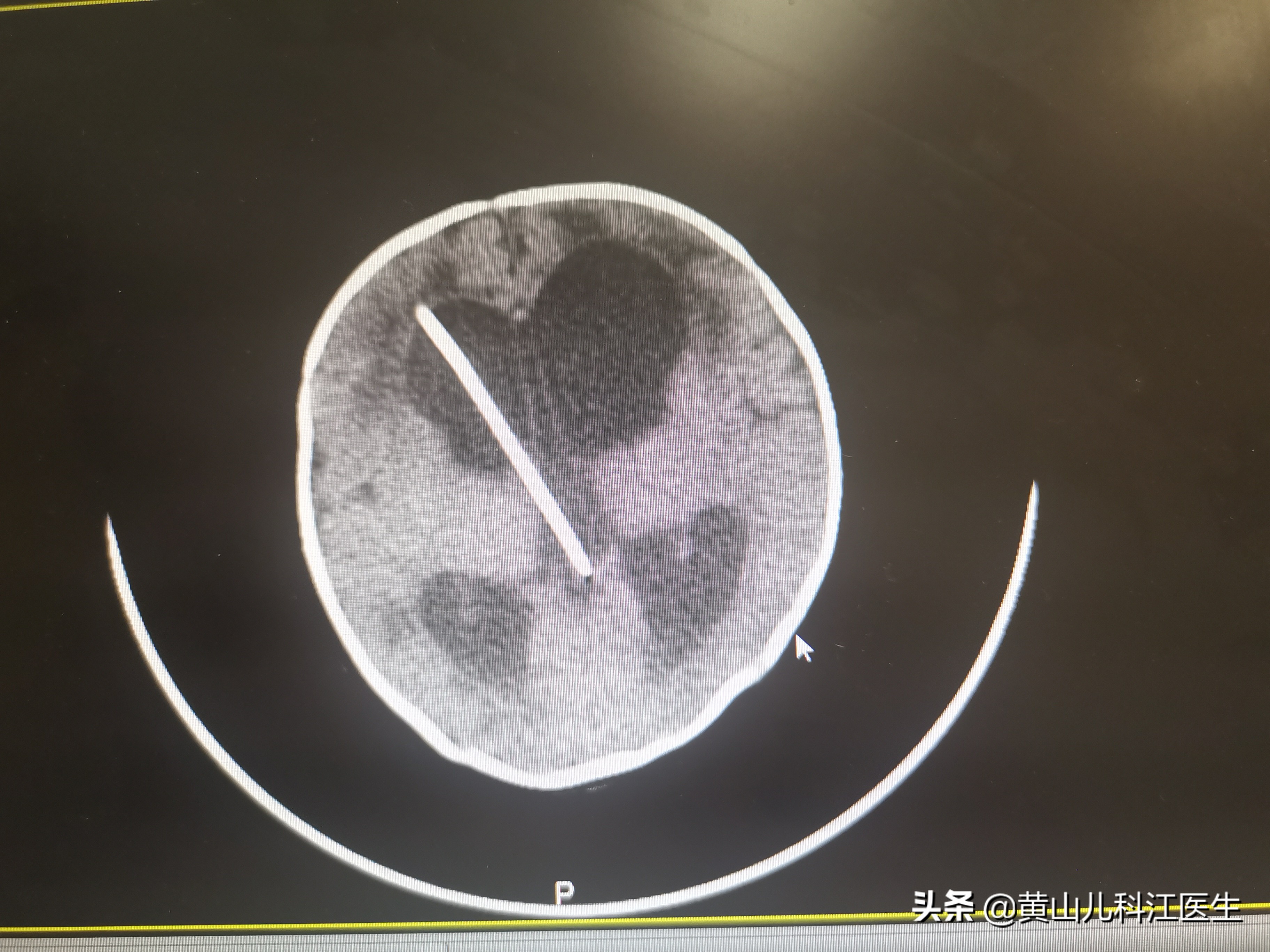 新生儿化脓性脑膜炎引起的脑积水,宝宝脑膜炎脑积水引流