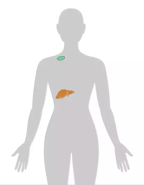四个早期症状告诉你得了癌症,四种情况你有癌细胞