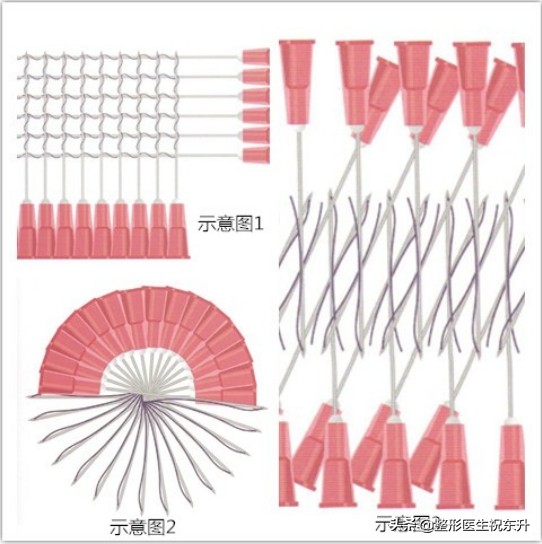 埋过线还能做拉皮吗,面部埋线提升颧骨变得很高怎么办