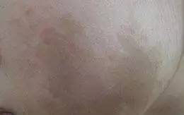 各种面部斑图片,如何辨别脸上的斑