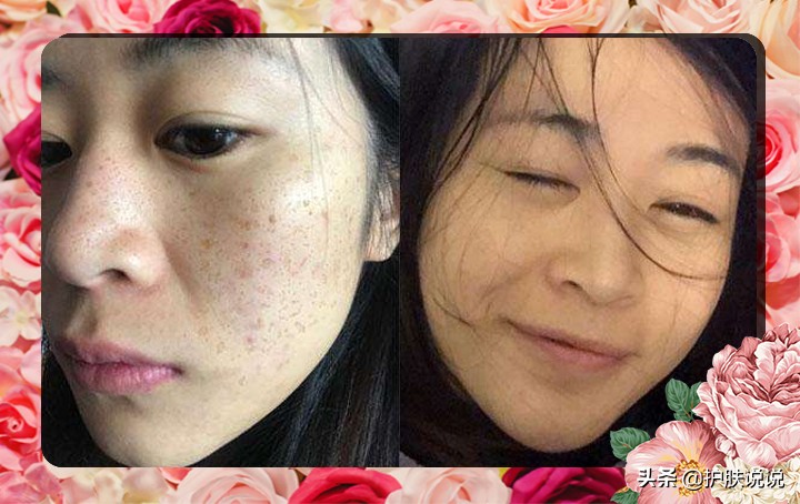 光子嫩肤最全介绍,光感美白和嫩肤美白有什么区别