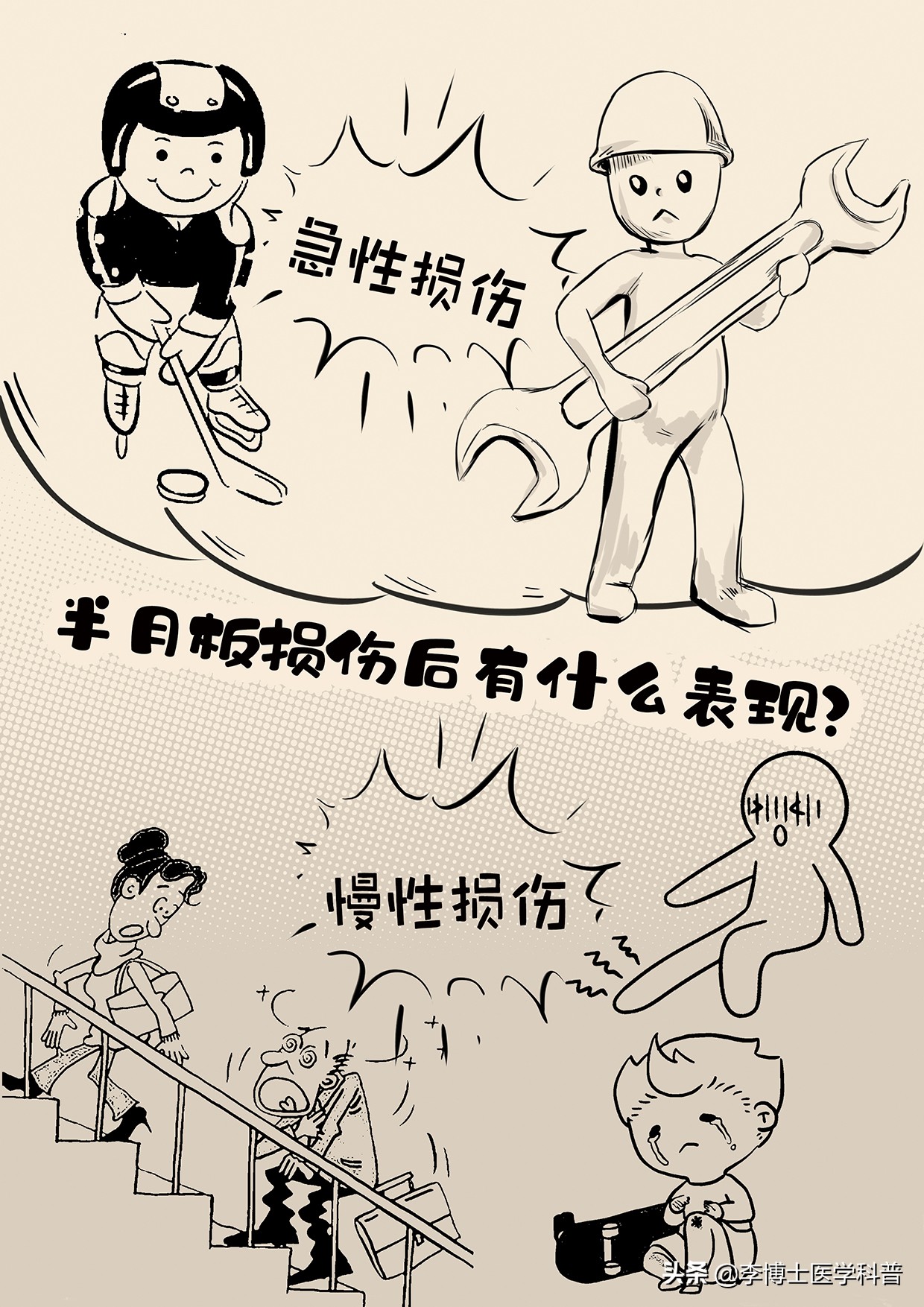 半月板深度科普,半月板损伤的医学解释