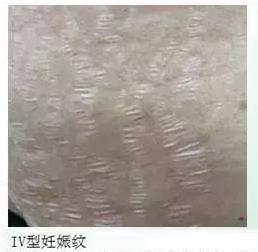 妊娠纹怎么消除才最快最有效,如何快速消除妊娠纹的有效方法