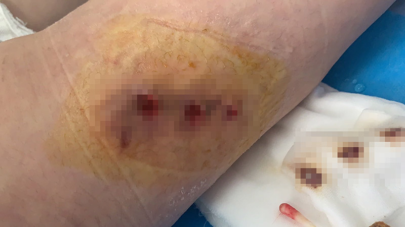 漯河一妙龄女子花2万元美腿，结果悲剧“一走路就疼”