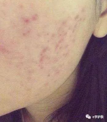 痘印和色斑怎么区别,痘印和斑点肌肤怎么护理