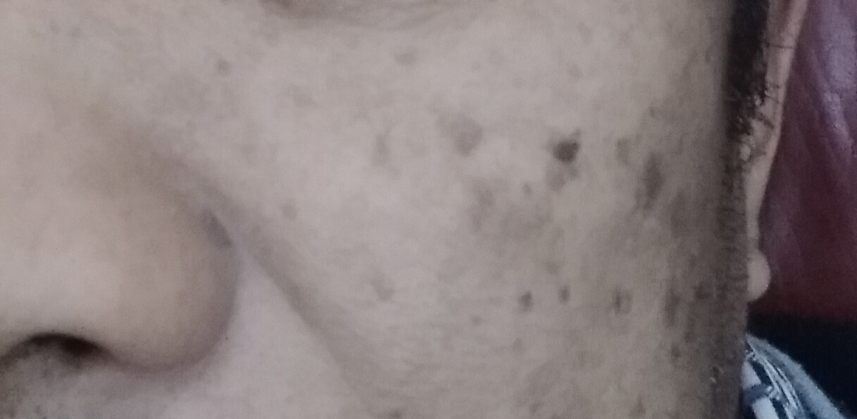 脸上被太阳晒的黑斑怎么去除,脸上长黑斑怎么去除最快方法