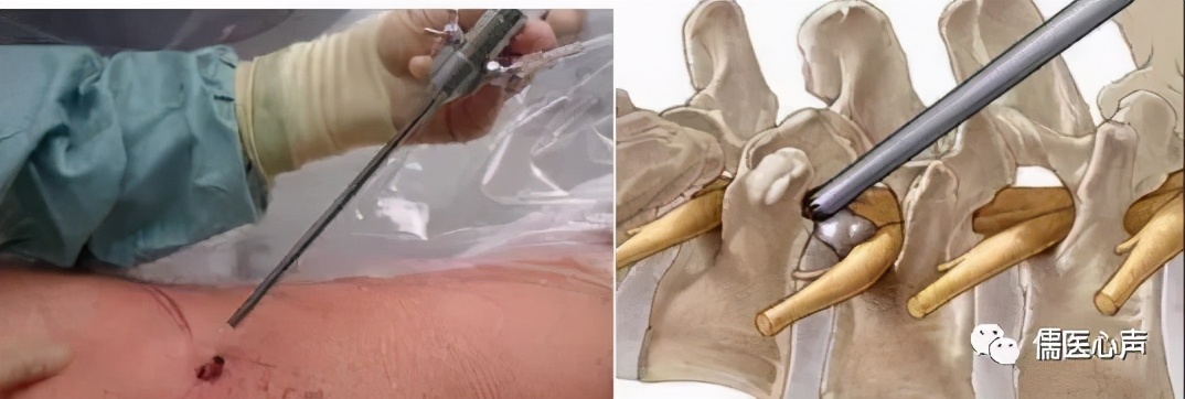 切除椎间盘腰腿痛是否立即消除,椎间盘膨出腰腿疼怎么办