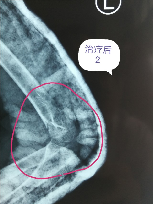 骨折的微创手术有后遗症吗,骨折的微创手术需要多少钱