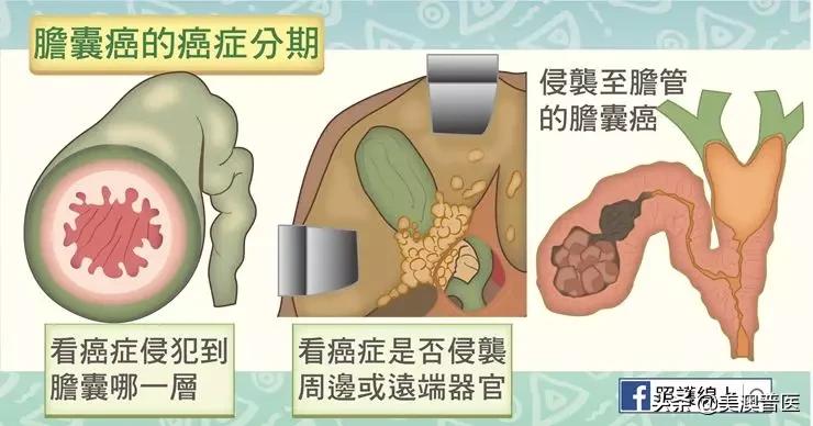 胆结石不治疗会拖成胆囊癌？有几点要特别注意