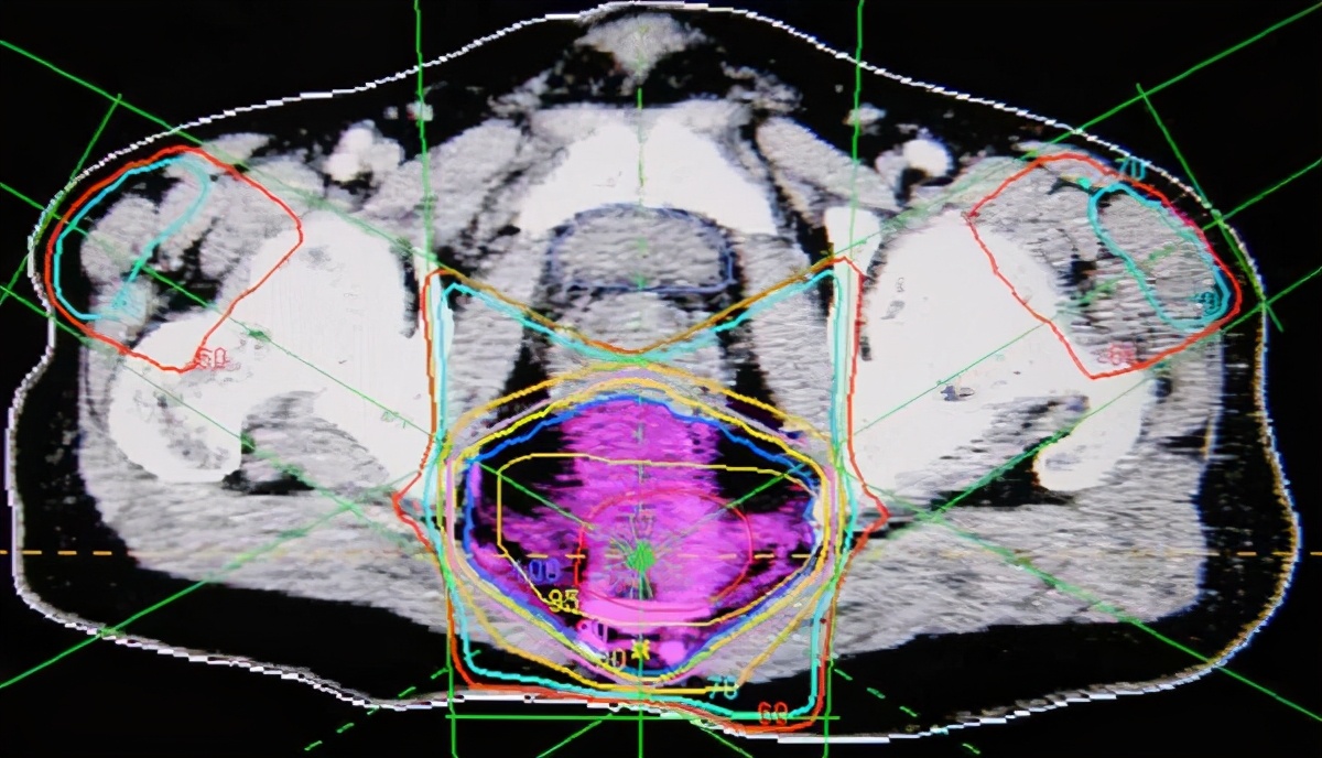 直肠癌术后复发影响因素研究进展,直肠癌术后局部复发病例怎么诊断