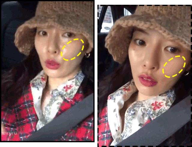 花10万打玻尿酸经验总结,花了将近十万打玻尿酸没有效果