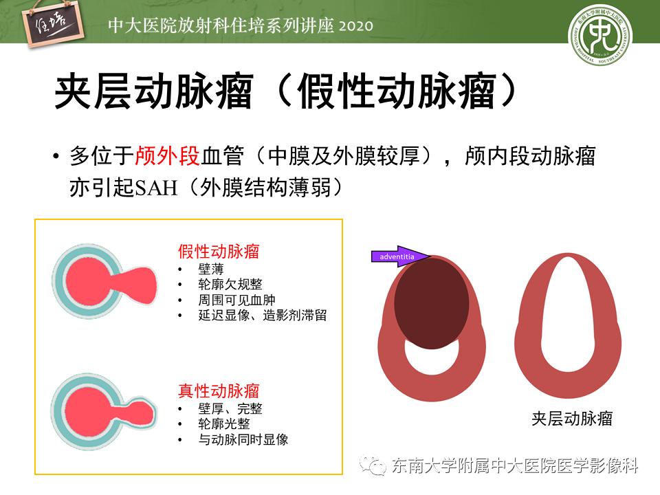 颈动脉夹层的超声表现及漏诊分析,动脉夹层与夹层动脉瘤是一样的吗