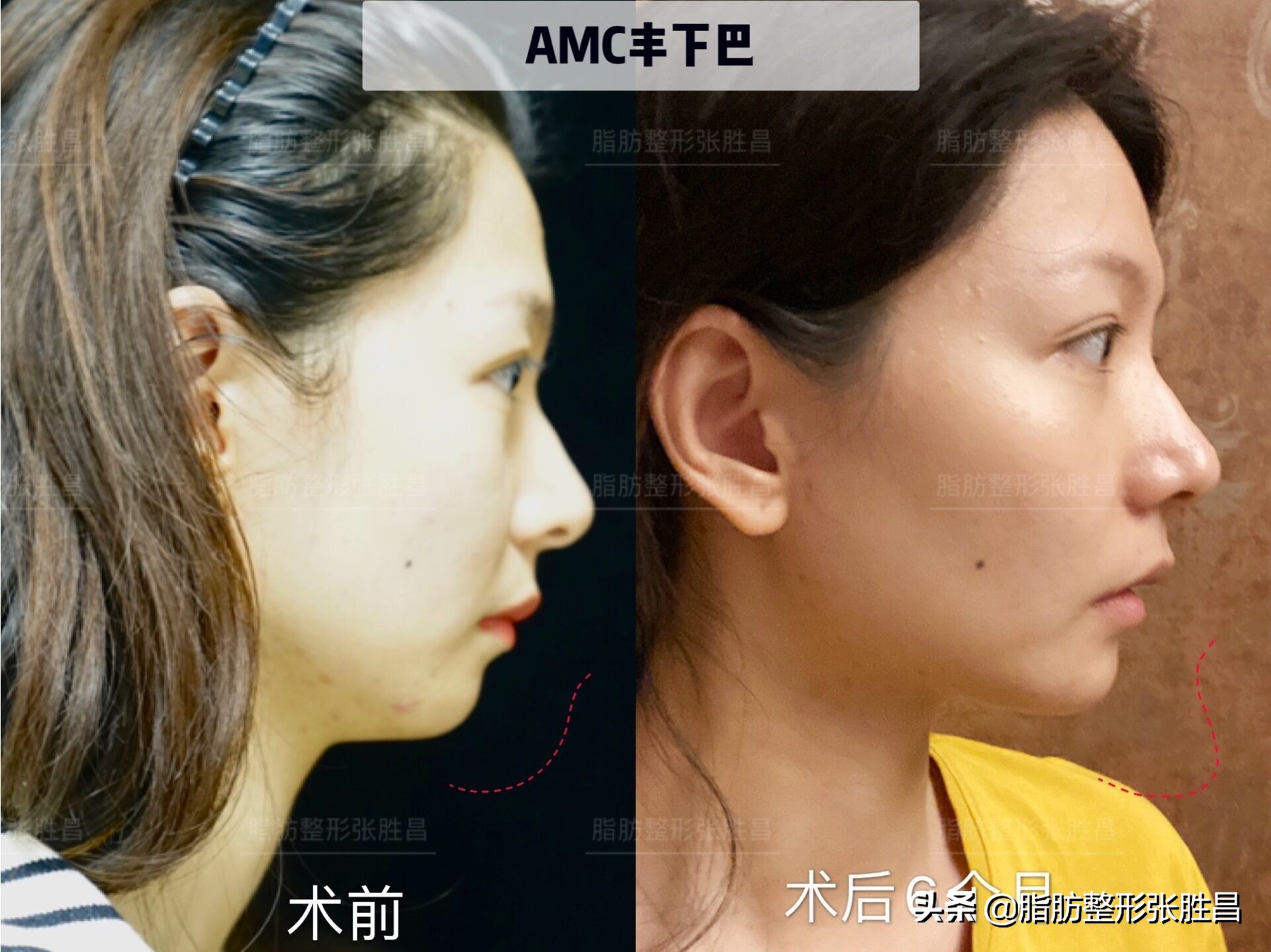 下巴缩短整容女,下巴短小北京