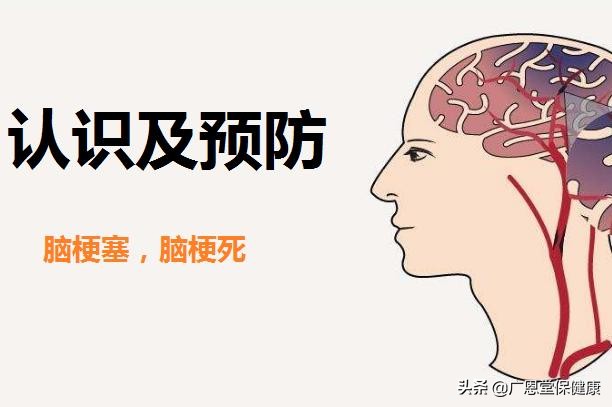 预防脑梗塞的小妙招,防止脑梗塞的最好方法