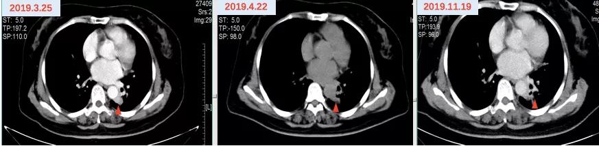 口服长春瑞滨出现耐药性了,口服长春瑞滨要吃多久
