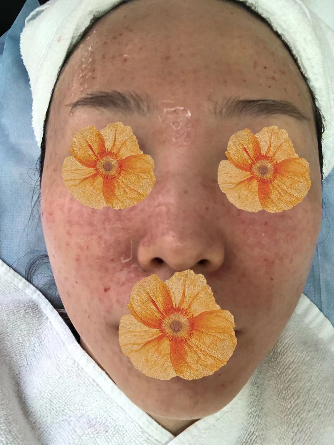 我的医美笔记-水光针