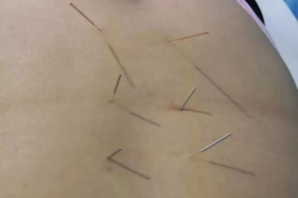 会阴神经痛针灸治疗穴位,康复理疗坐骨神经痛