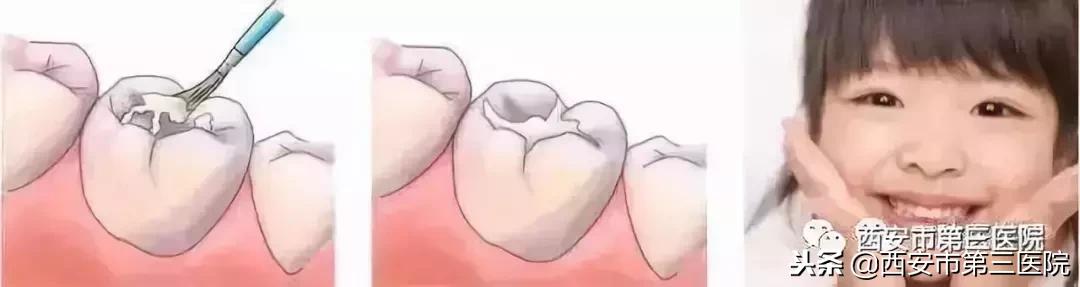 宝宝门牙变黑了怎么补救,孩子从小爱美好不好