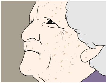 老年斑和皮肤癌出现溃烂流血,别再让老年斑溃烂成皮肤癌