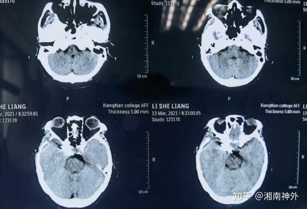 脑动脉瘤的定时炸弹,颅内定时炸弹