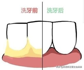 牙齿缝里有牙结石怎么才弄得掉,牙结石去临泉哪里洗牙好