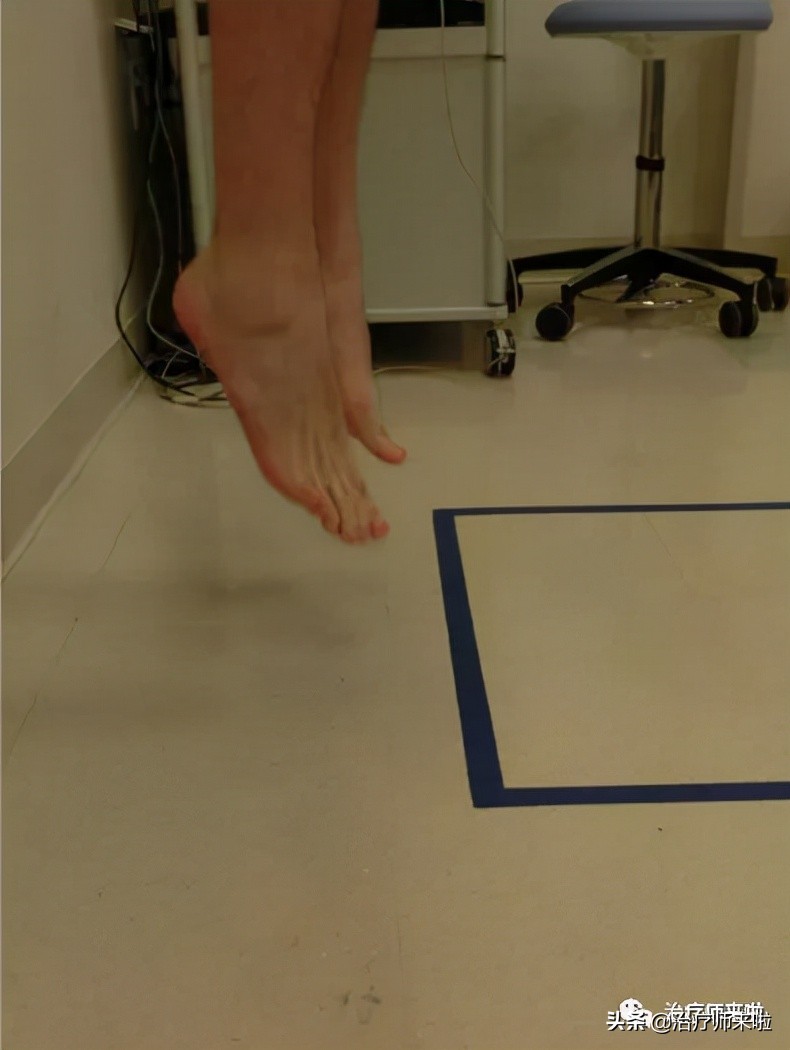 踝关节韧带重建康复北医三院,踝关节韧带重建手术后遗症