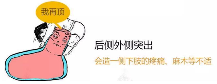 此文章让你彻底明白什么是:腰间盘突出