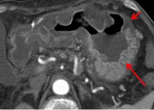 腹部ct能看出来胃的毛病吗,如果胃有问题腹部ct看得出来吗