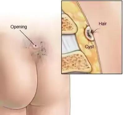 尾巴骨中间长痘痘特别疼,尾巴骨疼腿麻怎么回事