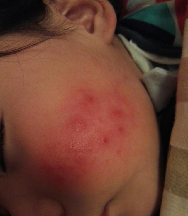 儿童脚冬天生冻疮用什么药最好,冬天脸上起冻疮怎么办